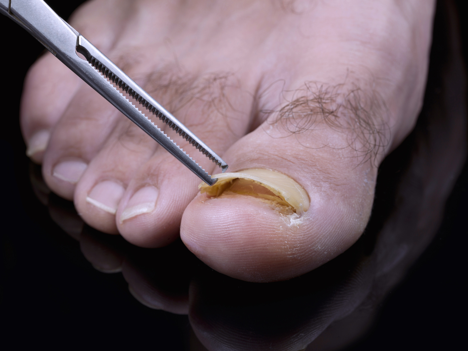 Causes of Big Toe Nail Changing Color and Falling Off - wide 2